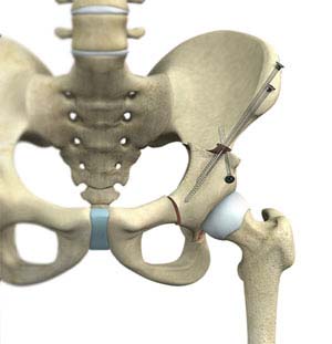 Hip Fracture Prevention