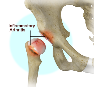 Inflammatory Arthritis of th