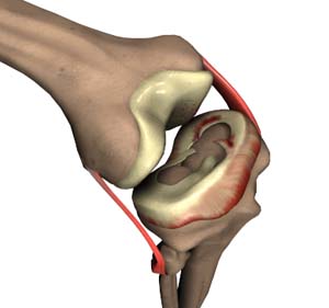 Meniscal Tears