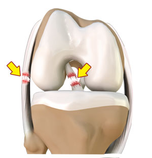 Multiligament Instability