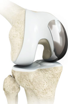 Unicompartmental Knee Replacement