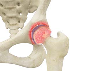 Hip Synovitis